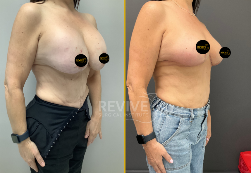 Before and after breast revision, frontal view showing improved shape and symmetry