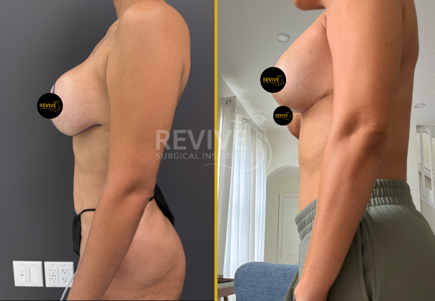 Before and after breast revision surgery, oblique and side view comparison
