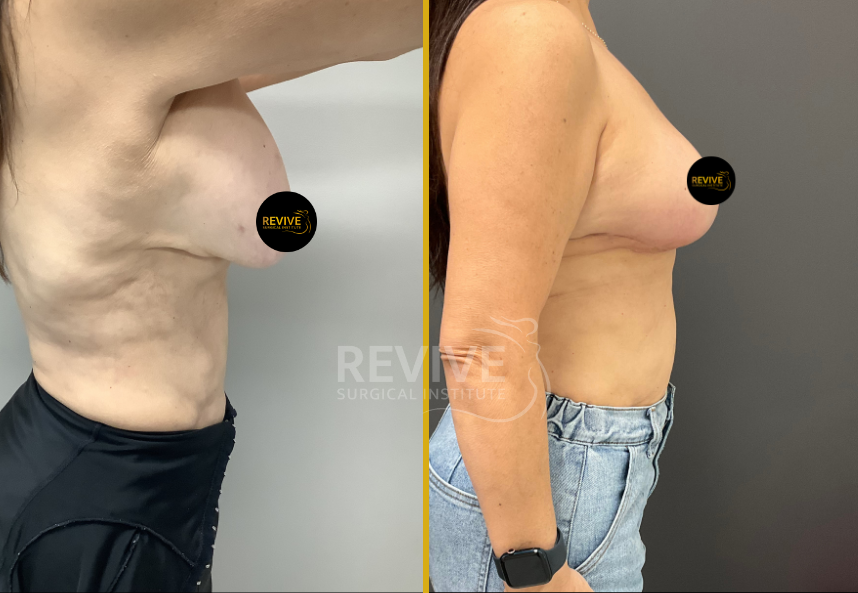 Before and after breast revision, side view showing enhanced contour and projection