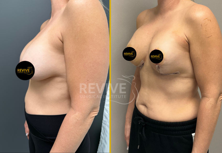 Before and after breast revision surgery, side profile view showing surgical changes and results