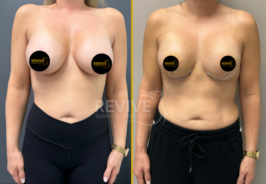 Before and after breast revision surgery, frontal view showing surgical changes and results