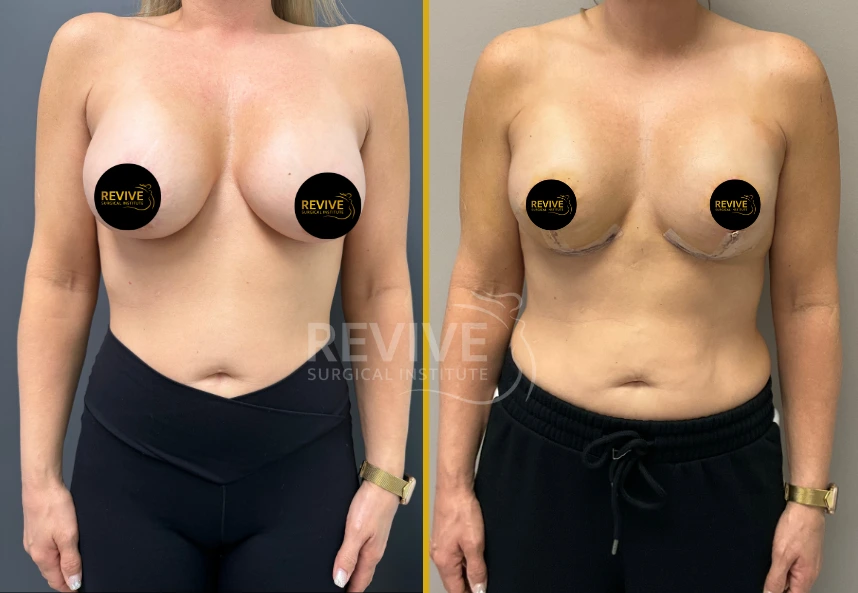 Before and after breast revision surgery, frontal view showing surgical changes and results