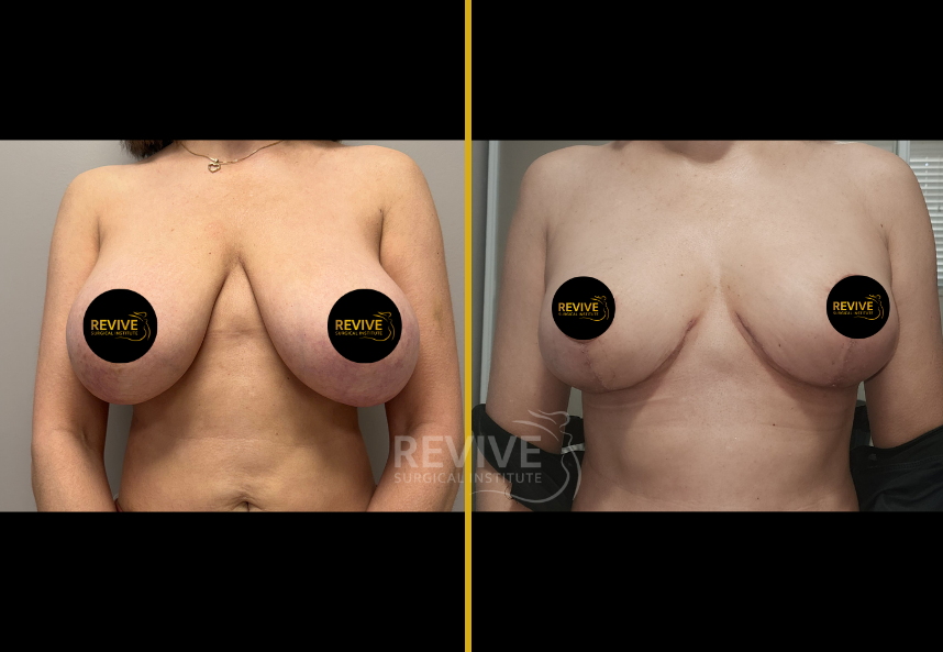 Before and after breast revision surgery, frontal view showing improved symmetry and projection