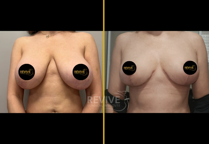 Before and after breast revision surgery, frontal view showing improved symmetry and projection