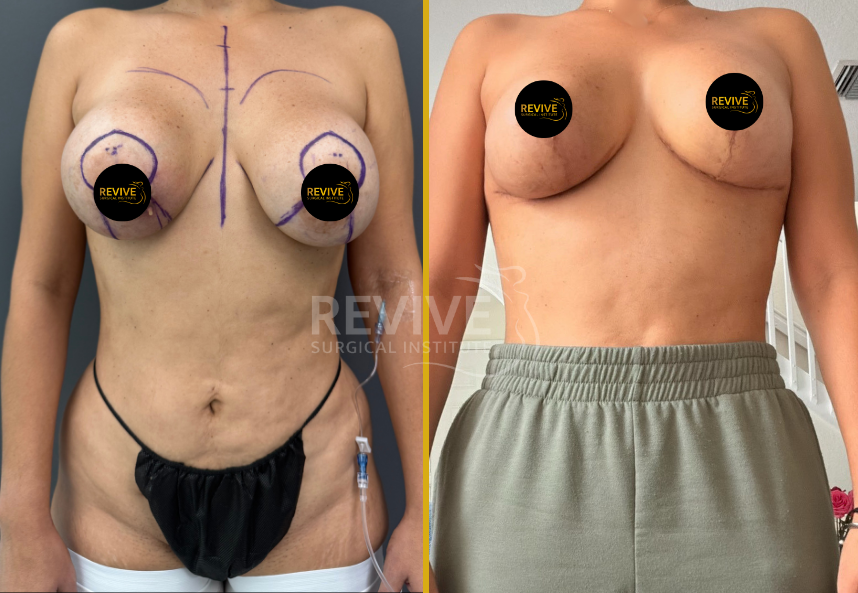 Before and after breast revision surgery, front and side views with surgical markings