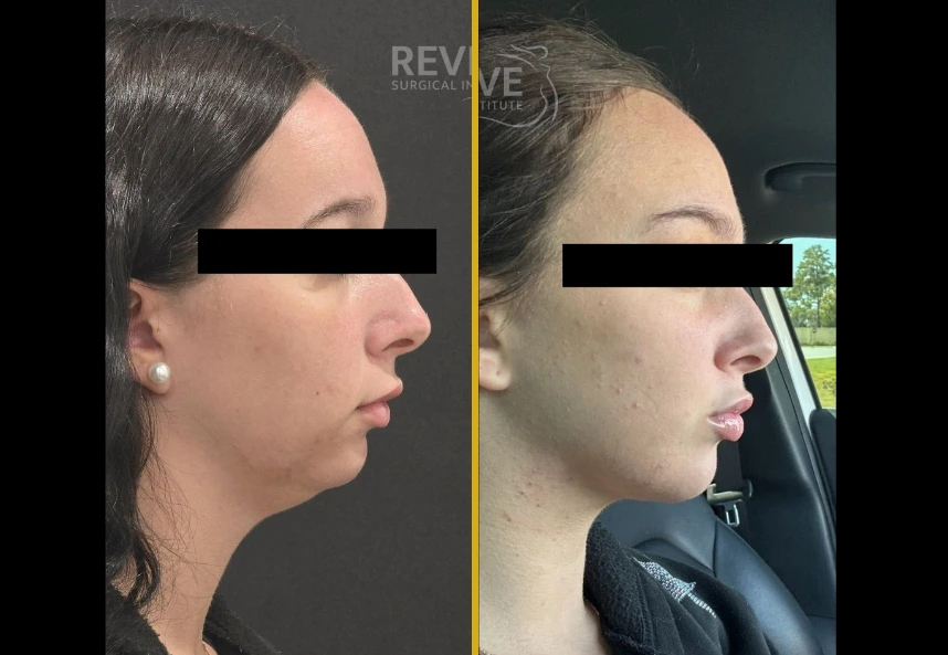 Before and after profile views of chin liposuction results showing reduced fullness under the chin