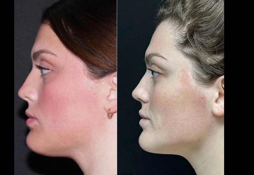 Before and after profile view of chin liposuction results showing reduced fullness under the chin