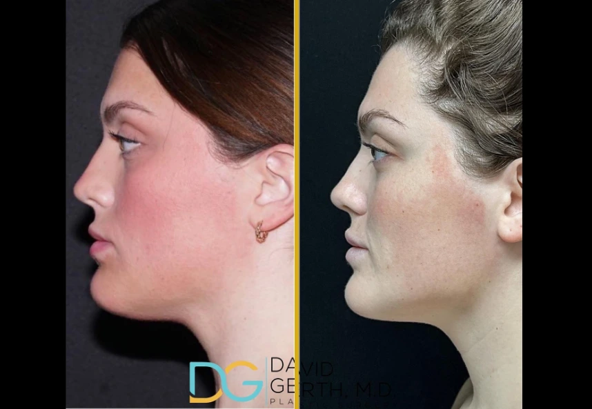 Before and after profile comparison of chin liposuction results showing reduced fullness under the chin