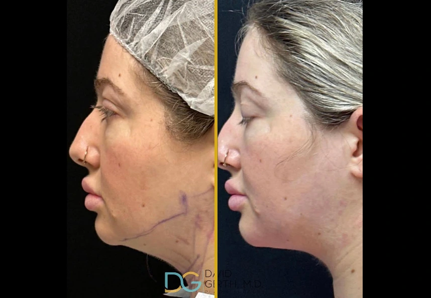 Before and after profile views of chin liposuction results showing improved jawline definition