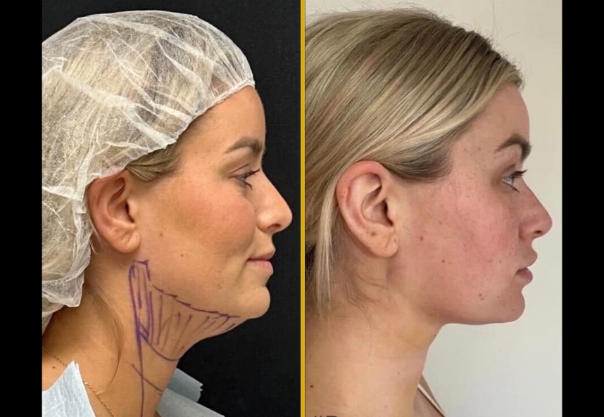 Chin liposuction before and after: left shows marked surgical plan, right shows refined jawline definition
