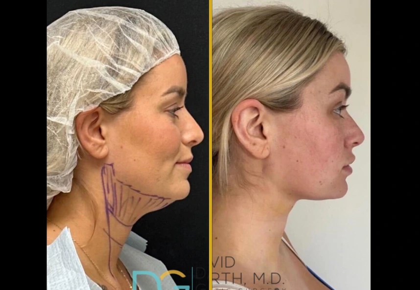 Before and after profile views of chin liposuction results, showing reduced fullness under the chin and improved jawline definition