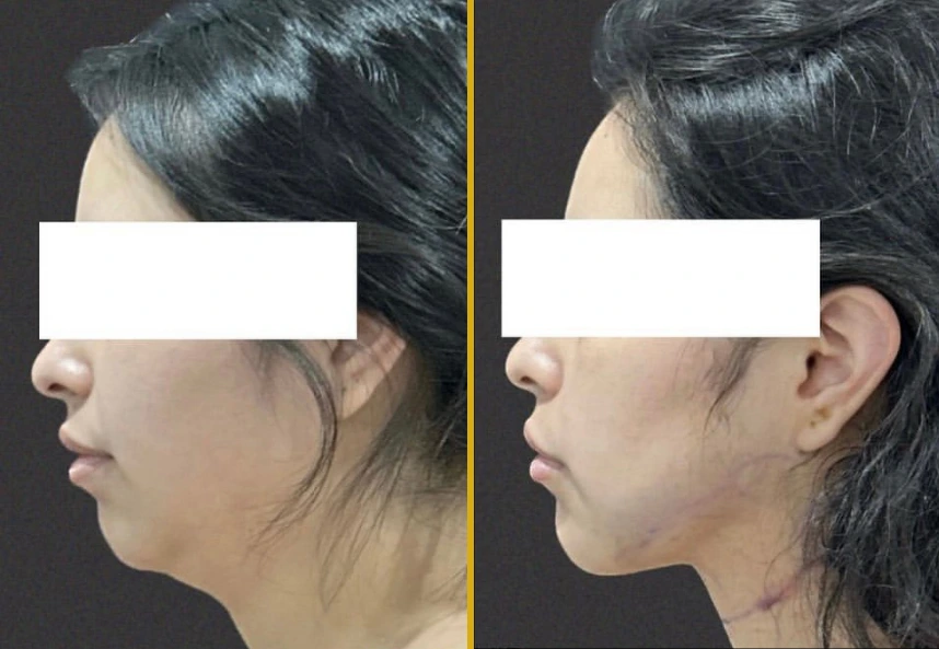 Chin liposuction before and after, profile view showing reduced fullness under the chin