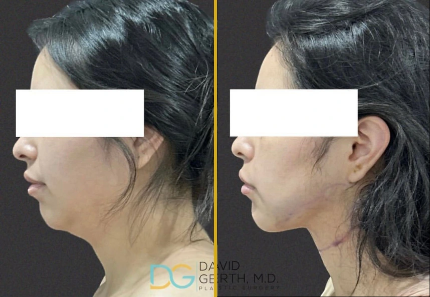 Before and after profile views of chin liposuction results by Dr. Gerth