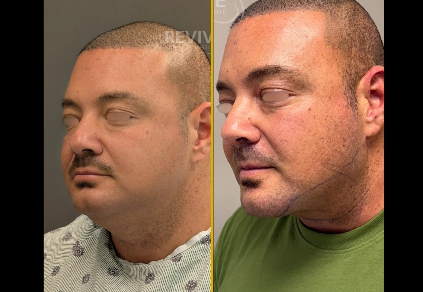 Before and after profile views of a male patient showing chin definition improvement following liposuction