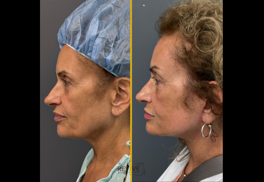 Facelift & Neck lift