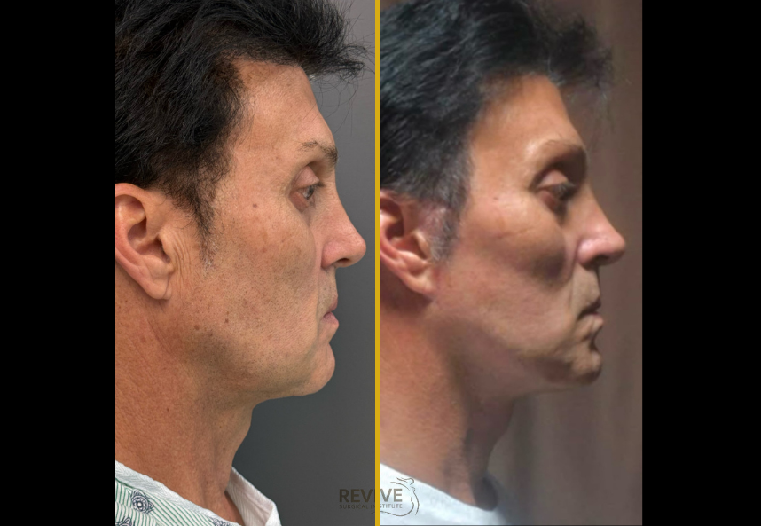 Facelift & Neck lift (2)