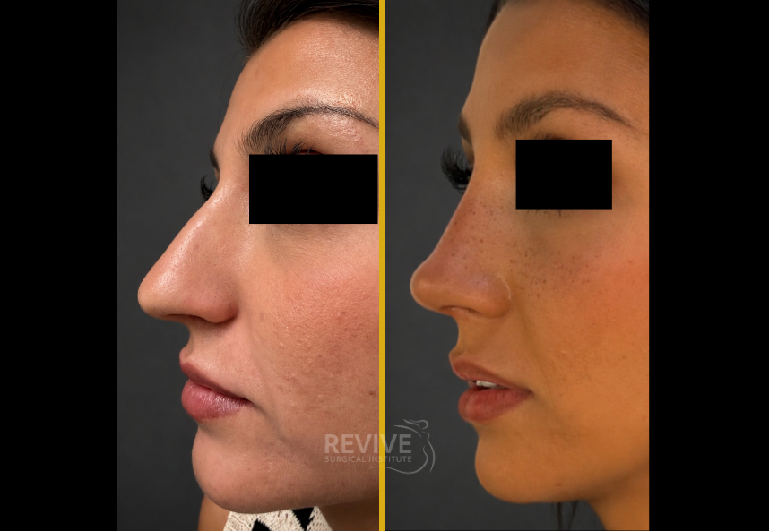 Before and after profile view of facelift, neck lift, and blepharoplasty results