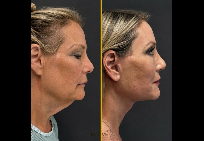 Facelift, Neck lift & Bleph