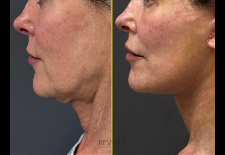 Facelift, Neck lift & Bleph (2)