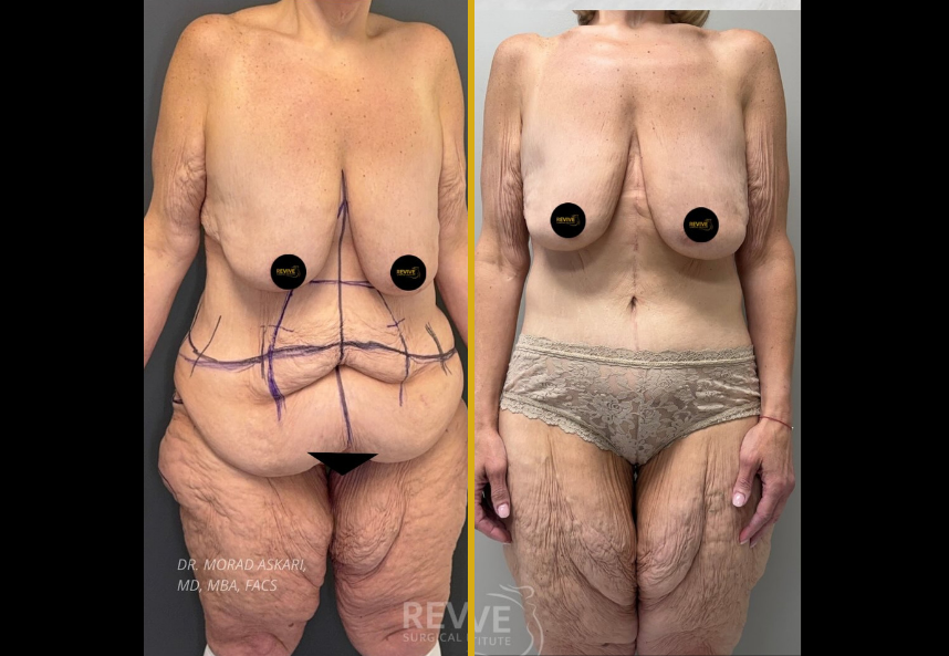 Before and after body contouring with fleur-de-lis technique and gynecomastia treatment, frontal view