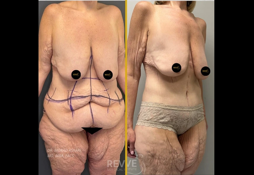 Before and after chest and abdominal contouring with fleur-de-lis technique and gynecomastia treatment, front and back views