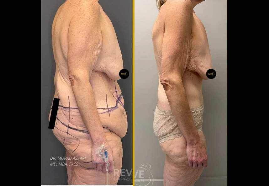 Before and after side profile comparison of male patient showing chest and abdominal contour improvement after fleur-de-lis gynecomastia surgery with surgical markings visible on left image