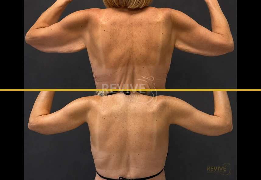 Before and after long scar brachioplasty showing patient's back with toned, lifted arms