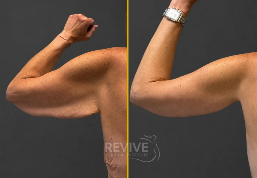 Before and after brachioplasty showing improved arm contour with reduced loose skin