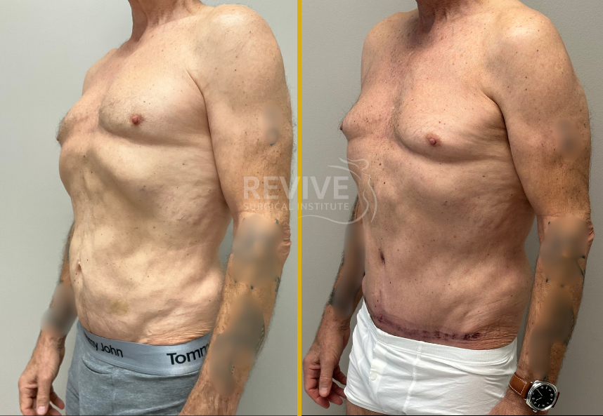 Male tummy tuck before and after, side view
