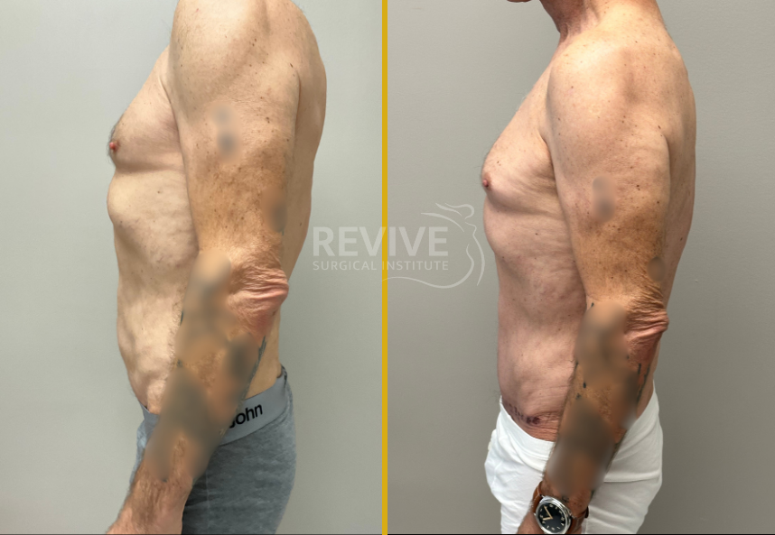 Before and after male torso showing side profile comparison