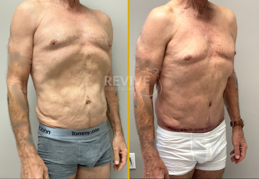 Before and after male torso showing front view comparison