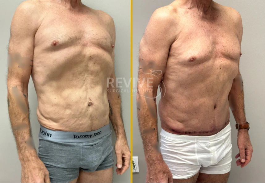 Before and after male torso showing front view comparison