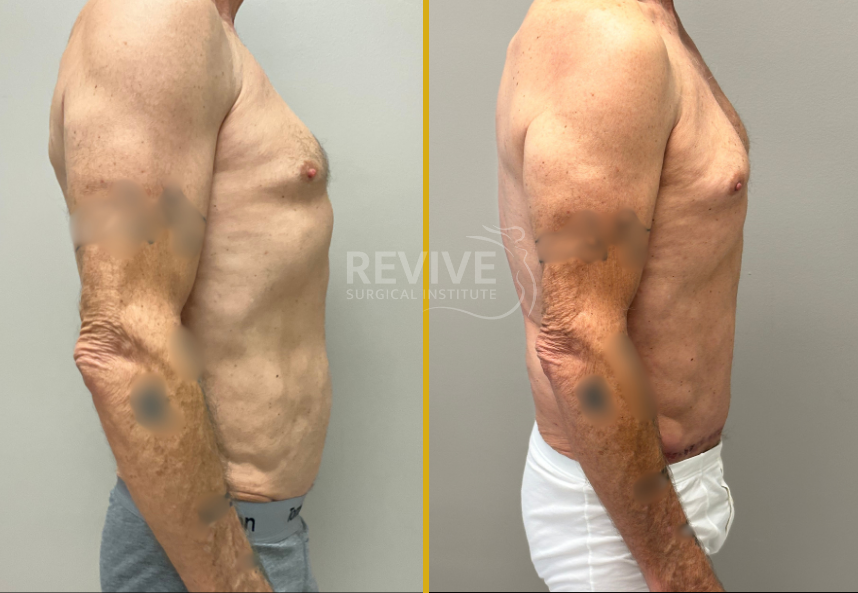 Before and after male torso showing side profile comparison