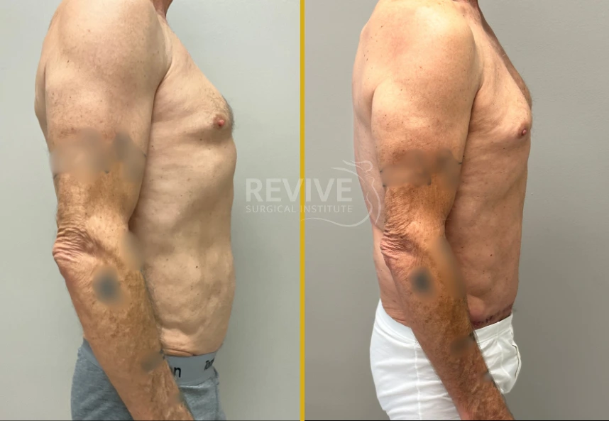 Before and after male torso showing side profile comparison