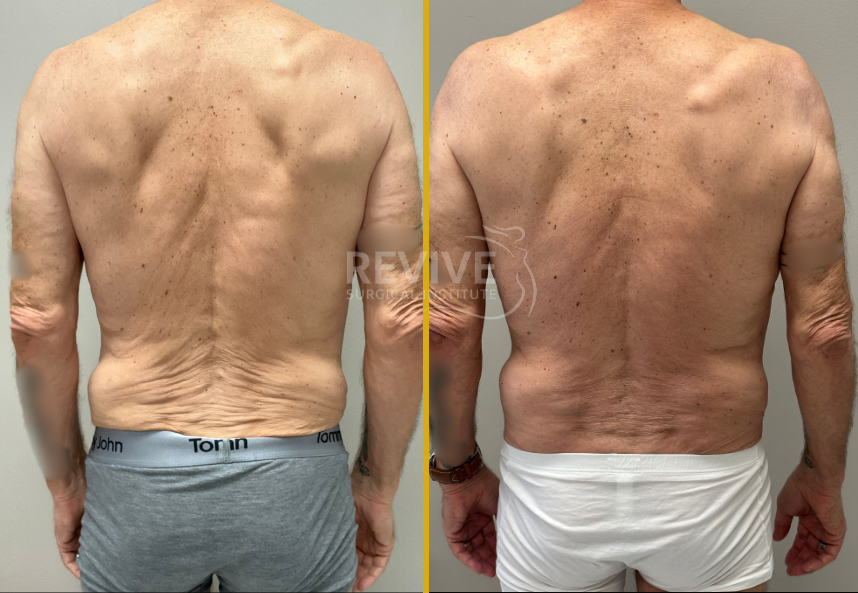 Before and after male back view showing comparison