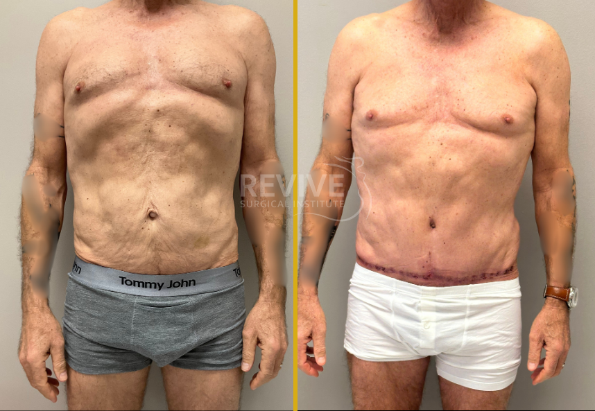 Before and after male torso showing front view comparison