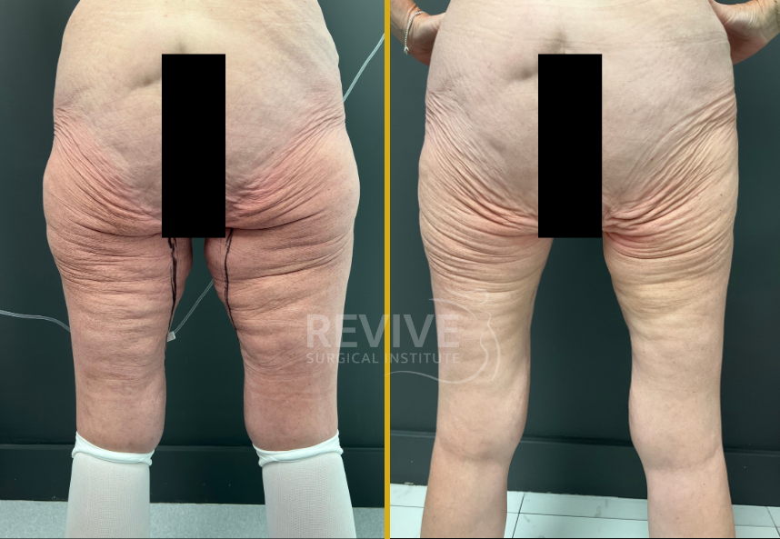 Before and after thigh lift showing patient's thighs with reduced sagging and improved skin texture