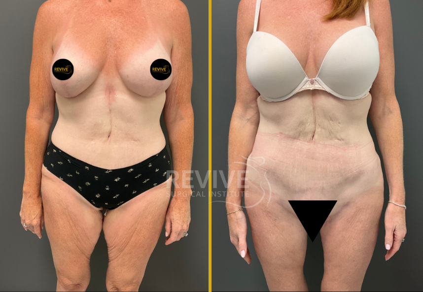 Before and after thigh lift and body contouring showing front view with improved thigh and torso definition