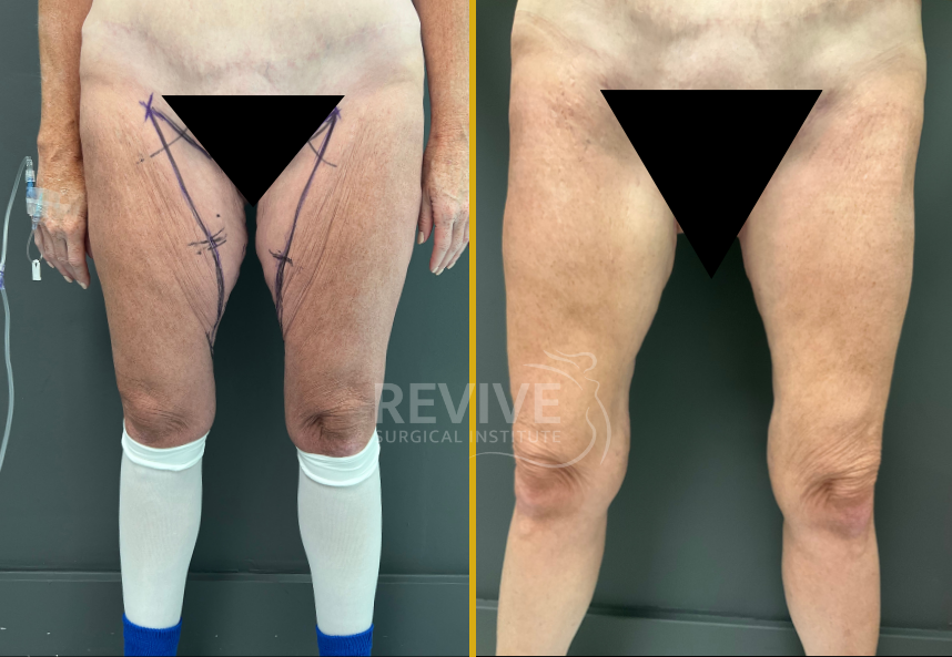 Before and after thigh lift showing patient with surgical markings pre-op and tightened thighs post-op