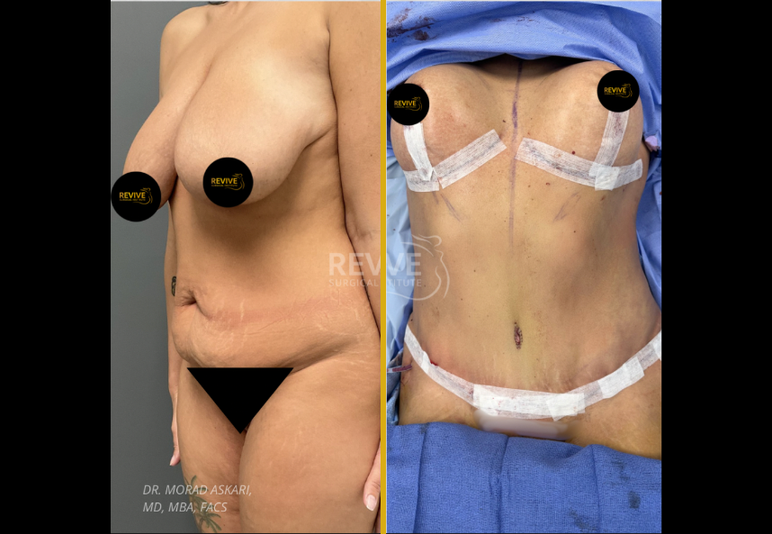 Before and after tummy tuck with breast lift and implants showing improved abdominal contour and breast shape