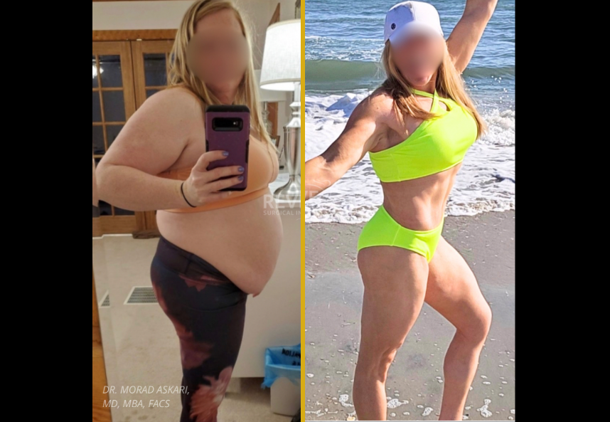 Before and after photos from weight loss case 23 showing patient's torso transformation