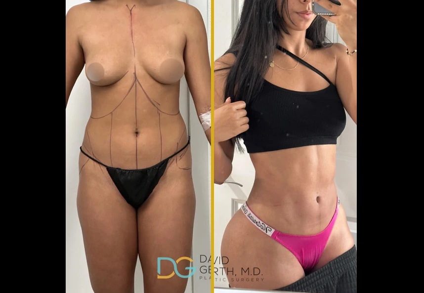 Before and after 360 BBL ab etching case showing front torso with surgical markings and post-procedure result