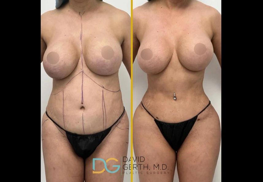 Before and after 360 liposuction case showing front torso view with reduced waist and abdominal contours