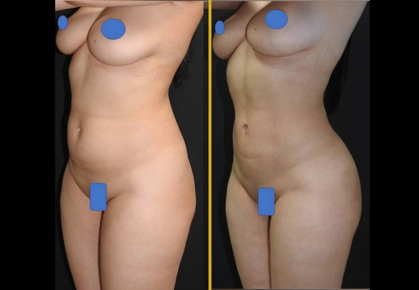 Before and after side-by-side comparison of 360° liposuction and Brazilian butt lift results, showing torso and lower body contours
