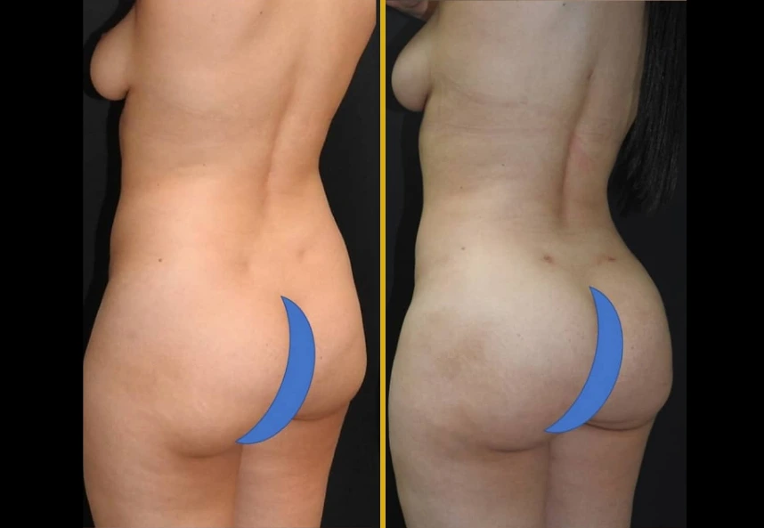 Before and after 360° liposuction and buttock augmentation showing enhanced curves and body contour