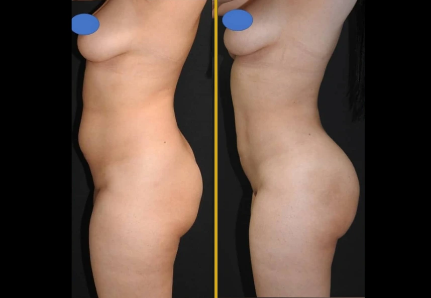 Before and after side profile showing 360° liposuction and Brazilian butt lift results