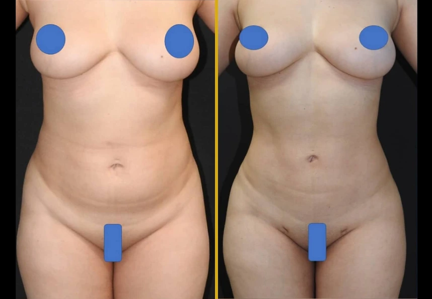 Before and after 360° liposuction and Brazilian butt lift results showing front torso view