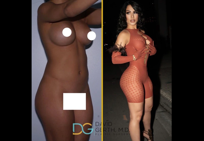 360 BBL and liposuction before and after results showing enhanced body contours