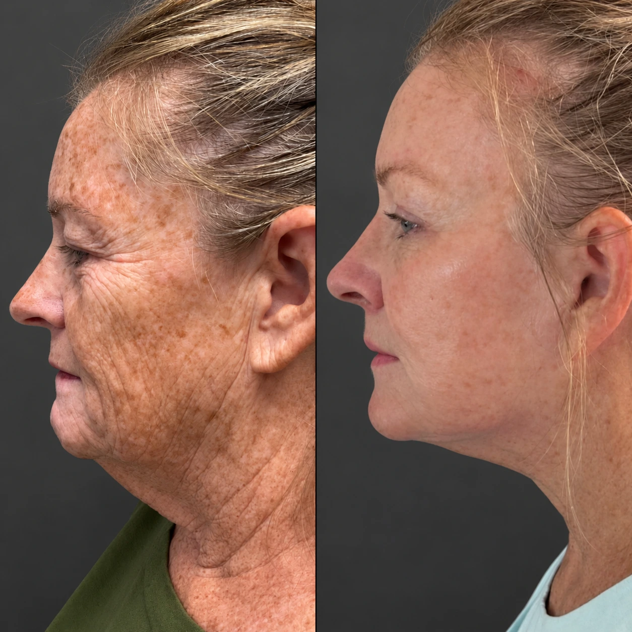 Before and after blepharoplasty patient profile