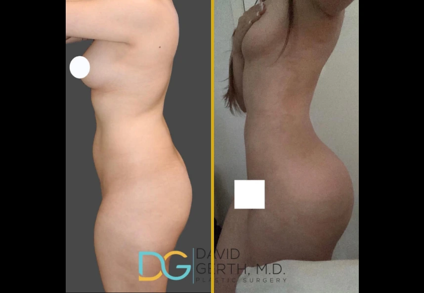 Before and after side profile comparison of BBL and liposuction results showing enhanced buttocks contour and improved waist definition